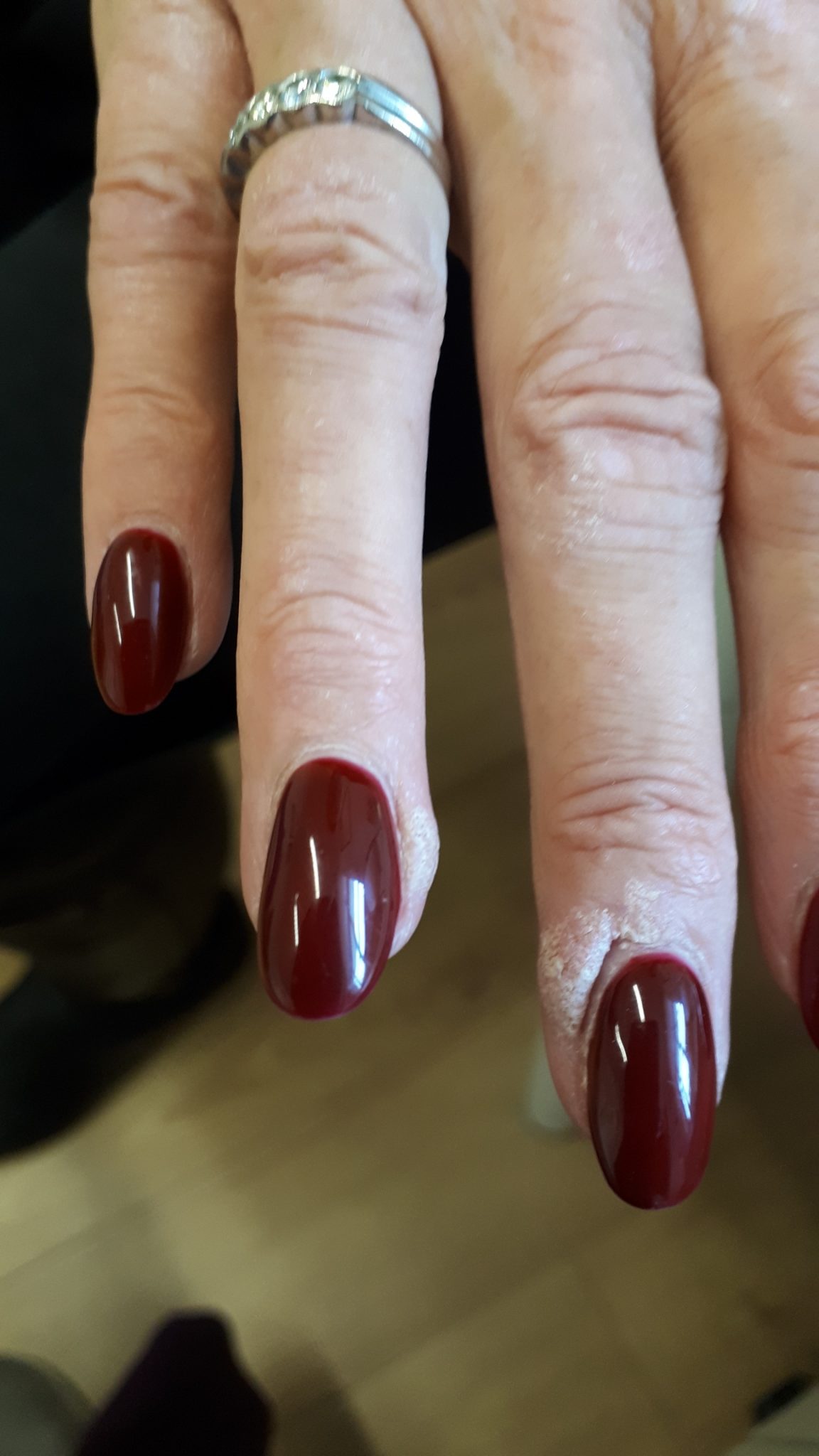 Wart Removal Inskin Clinic Altrincham, Manchester