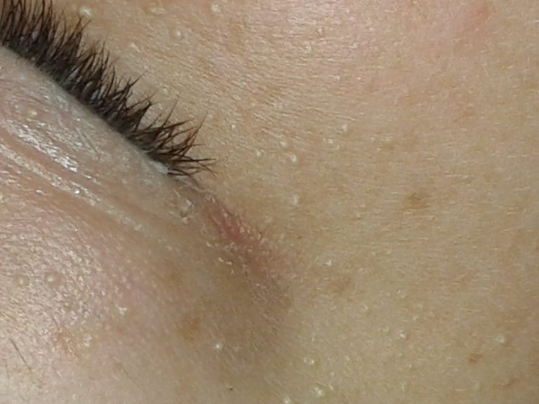 Milia Removal Inskin Skin Clinic Altrincham, Manchester Milia Removal Inskin Skin Clinic Altrincham, Manchester