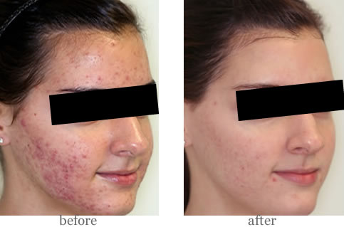 dermalux acne_before_after