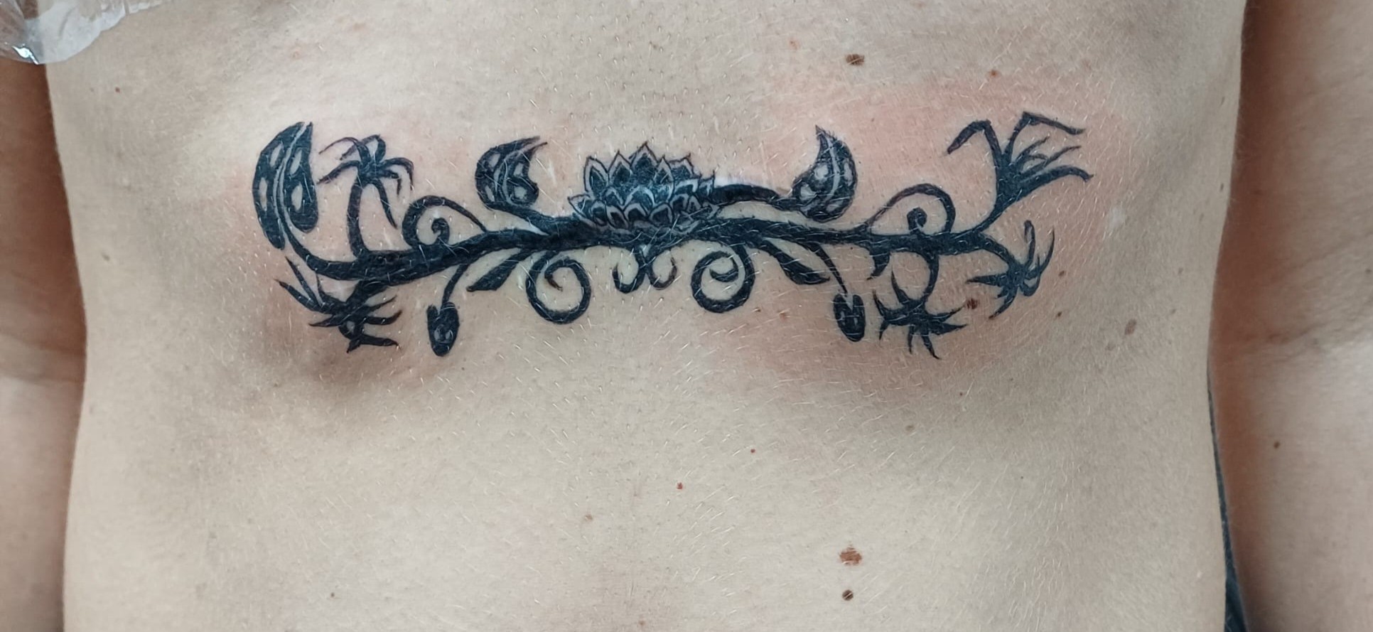 Can you see it??? have a look at our medical tattoos page to see what this design is covering